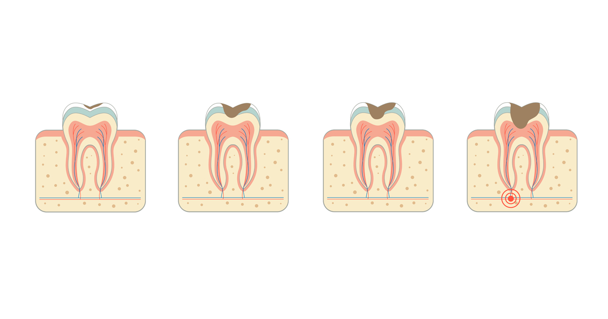 dca-blog_article-21_myths-and-facts-about-cavities_1200x630