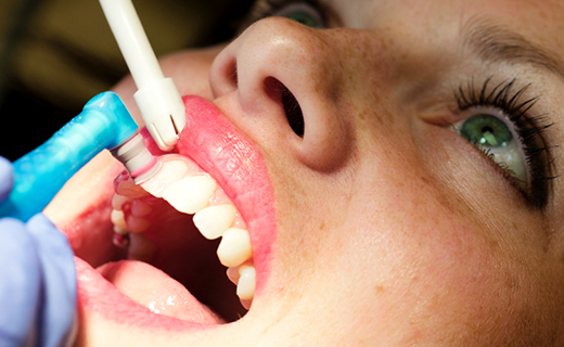 dca-blog_dental-hygienist-and-cleaning-face
